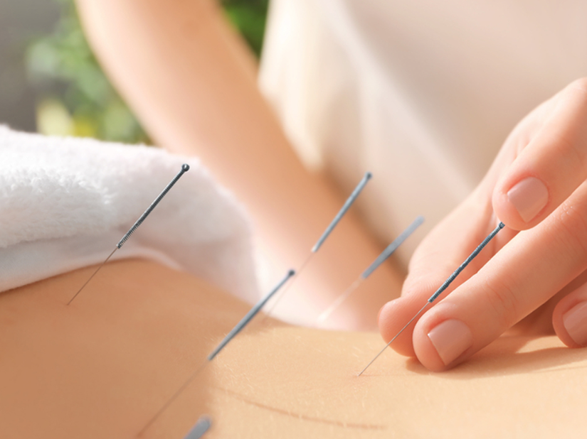 Acunpuncture in Dubai